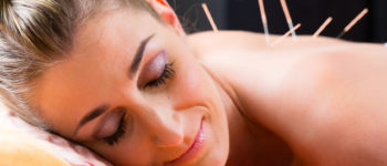 Frau bei der Akupunktur-Sitzung mit Nadeln auf der Rückseite mit alternativen Therapie